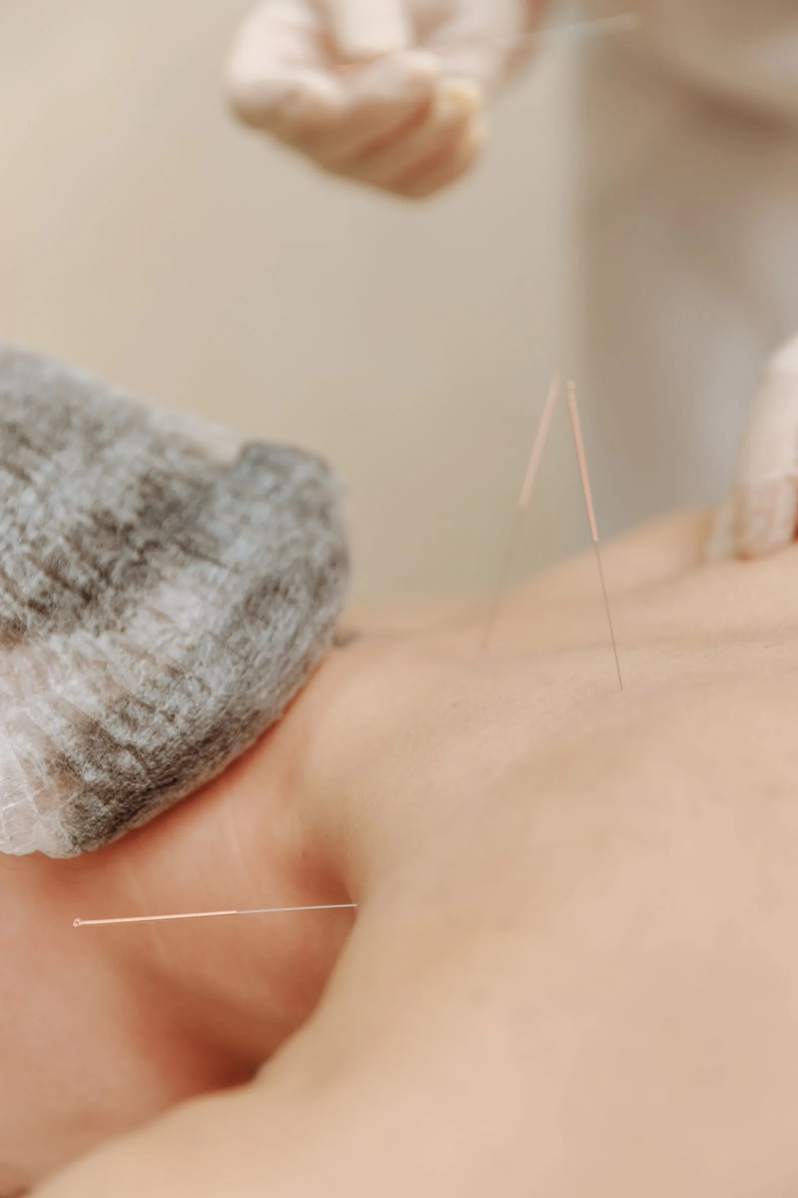 Close-up of acupuncture needles on a person back during treatment