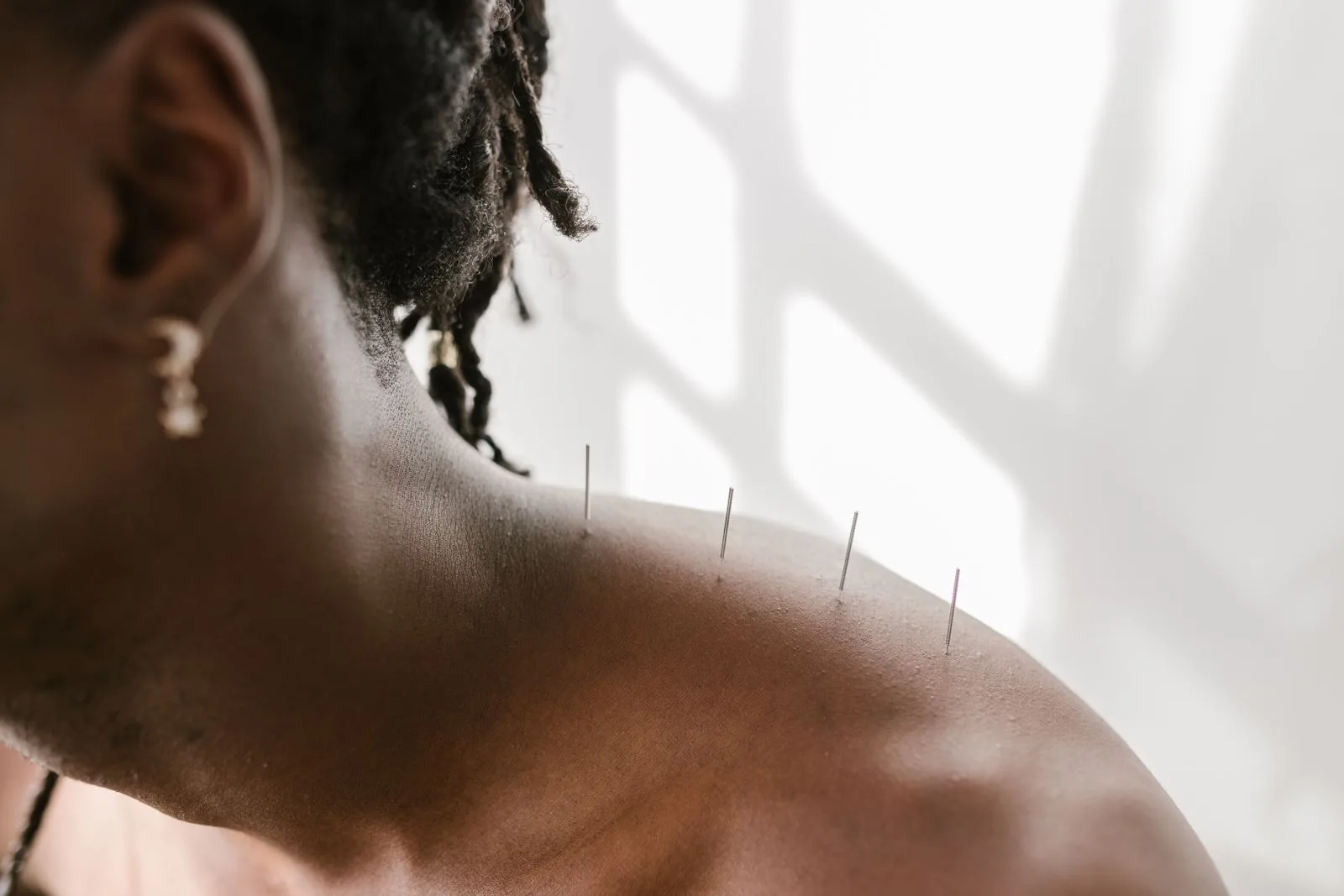 Detailed view of acupuncture needles applied to a shoulder